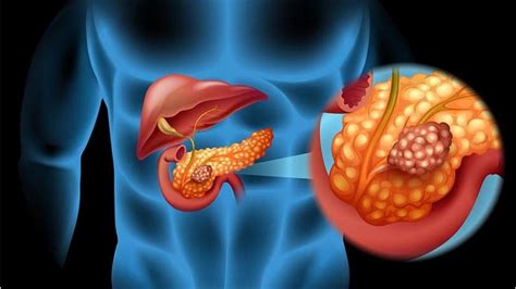 sintomas de cancer no pancreas-4